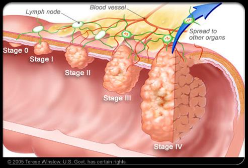 colorectal_cancer_s10_colorectal_cancer_stages