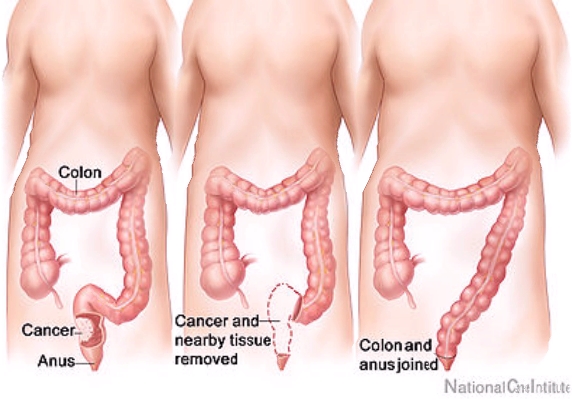 treatment-of-colon-cancer-320x200